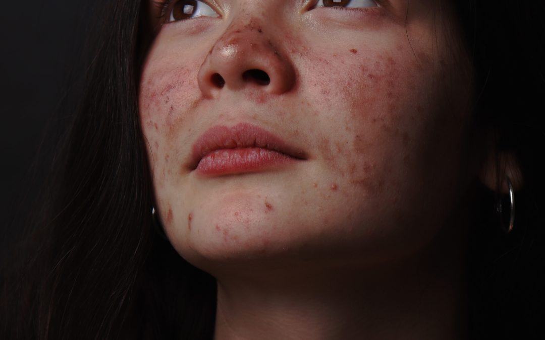 How Different Types of Acne Respond to Laser Treatment